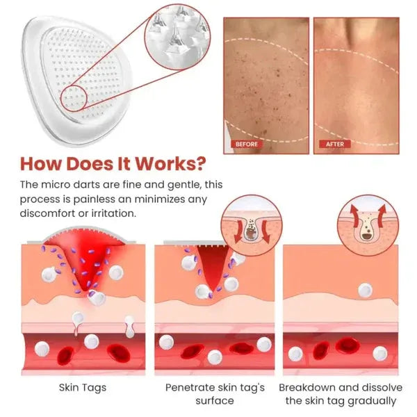 DermaSmooth Skin Tag Remover